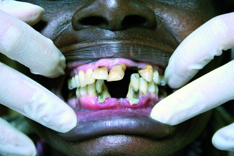 2. Quadro di parodontite severa su paziente adulto residente nei pressi di Meru. 