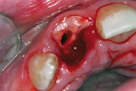 1. Un esempio di severo trauma dento-alveolare. 