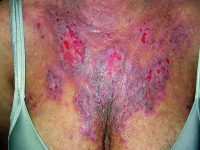 2. Dermatite eczematosa cronica nella paziente M.S.