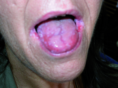 4. Lesioni muco-membranose al cavo orale nella paziente C.M. 