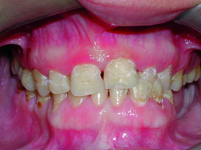 8-9. Quadro odontostomatologico della paziente M.S.  