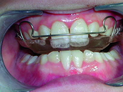 10-11. Quadro odontostomatologico del paziente C.V.  