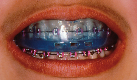 6. Un modello di paradenti semi-individuale di nuova generazione (Boil and Bite NG), che ben si adatta alle diverse situazioni orali; in questo caso ottimo per un paziente in terapia ortodontica. 