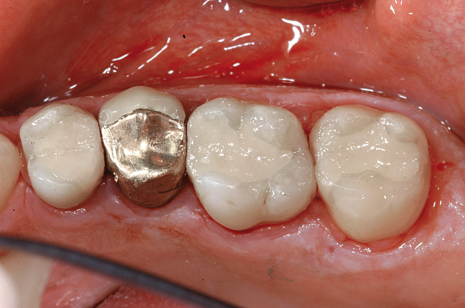 Valutazione clinica di un nuovo materiale per ricostruzioni dentali a lungo  termine. Dati preliminari di uno studio prospettico