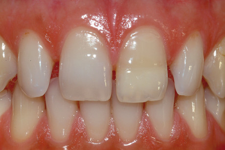 11. A 20 anni si osserva solamente una leggera pigmentazione, dovuta al fatto che il ponte dentinale altera i parametri della riflessione del colore attraverso lo smalto. I test di vitalità sono assolutamente normali