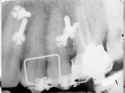 6. Radiografia endorale sinistra dopo l’applicazione delle miniviti.