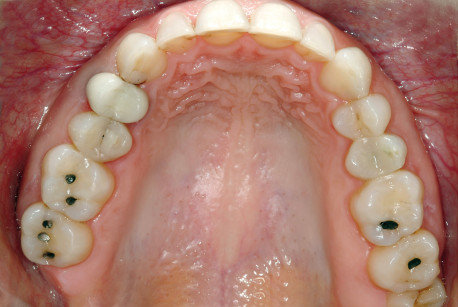 1.C-D: immagini preoperatorie dei denti posteriori che mostrano una perdita di tessuto relativamente contenuta. 