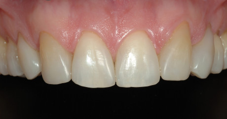 D-E: immagine post-operatoria del sorriso ricostruito, dopo sbiancamento e utilizzo di semplici procedure additive. 