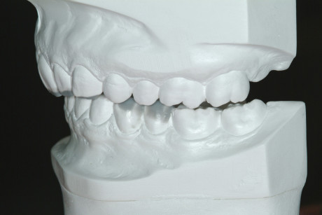 1. E–F: ceratura parziale anteriore a correzione dei denti anteriori abrasi; notare che la VOD è stata aumentata sui molari per assicurare lo spazio necessario per il build-up dei denti anteriori.