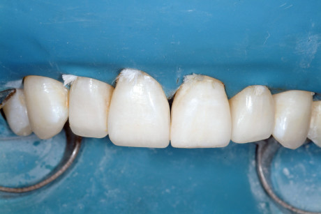 1. G–H: denti anteriori e posteriori sono stati restaurati mediante restauri diretti in composito conservativi, «senza preparazione» (Miris 2, Coltenewhaledent). 