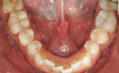 2. H-I: immagini intraorali dei denti posteriori restaurati mediante restauri diretti e indiretti (#36) in composito. 