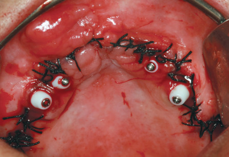 12. Immagine occlusale intraorale dopo la sutura. 