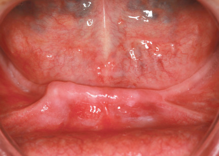 9. Immagine occlusale della cresta mandibolare edentula. 