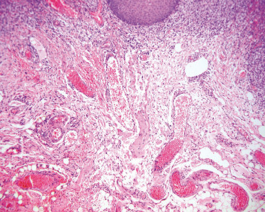 1A. Nel connettivo sottoepiteliale vi sono numerosi vasellini neoformati (Ematossilina Eosina, ingrandimento 250x).