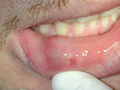 2A. Cisti mucosa da ritenzione del pavimento orale.
