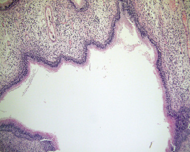 2C. Cavità cistica delimitata da epitelio duttale (Ematossilina Eosina, ingrandimento 250x).