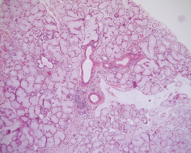 2D. Nel connettivo sottoepiteliale si osservano lobuli ghiandolari, alcuni di aspetto fisiologico, altri dilatati e aree di raccolta di muco (Ematossilina Eosina, ingrandimento 200x).