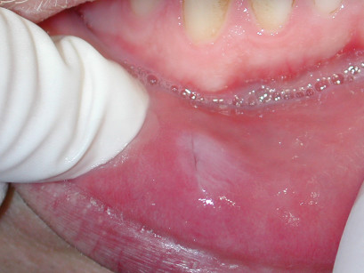 2F. Controllo post-operatorio del mucocele dal labbro inferiore.
