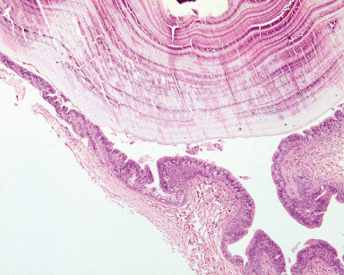 4C. A maggiore ingrandimento si osserva la parete del dotto e il calcolo (Ematossilina Eosina, ingrandimento 250x).