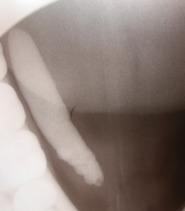 4D. Immagine radiografica del dotto di Warthon destro con calcolo radiopaco.