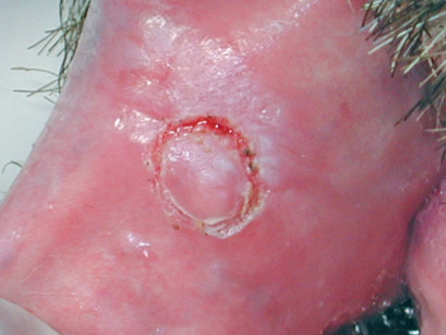 5B. Biopsia incisionale con il laser effettuata tra margine sano e margine patologico.