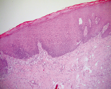 5C. Mucosa rivestita da epitelio squamoso cheratinizzante, acantosico con numerose lamelle cornee anucleate in superficie (Ematossilina Eosina, ingrandimento 200x).