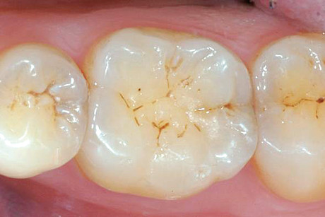 1. Lesione cariosa della porzione distale del solco principale dell’elemento dentale 3.6. 