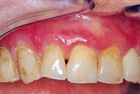 1. Lichen gengivale atrofico erosivo. Si noti il rilevante indice di placca, spesso presente in tali pazienti per l’oggettiva difficoltà nel mantenere l’igiene nel 3° cervicale degli elementi dentari.