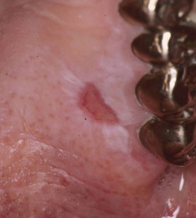 2. Lesione lichenoide orale: ai test epicutanei il paziente risultava ipersensibile a nichel, oro e argento.