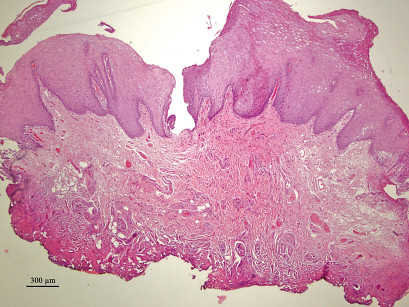 7. Immagine di ipercheratosi: campione di dimensione di 3,45 mm x 2,17 mm. Il margine chirurgico mostra la carbonizzazione (ematossilina-eosina; ingrandimento 40x).   