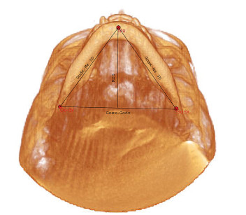 1. Visione assiale del cranio che evidenzia la differenza fra la lunghezza mandibolare rilevata in 3D e quella rilevata in 2D.