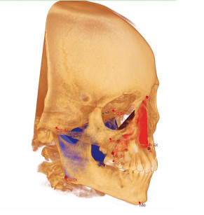 4, Punti cefalometrici individuati su rendering volumetrico del cranio. 