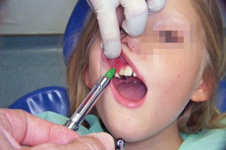 15. Esecuzione dell’anestesia nella zona del vestibolo precedentemente trattata con anestetico topico. 