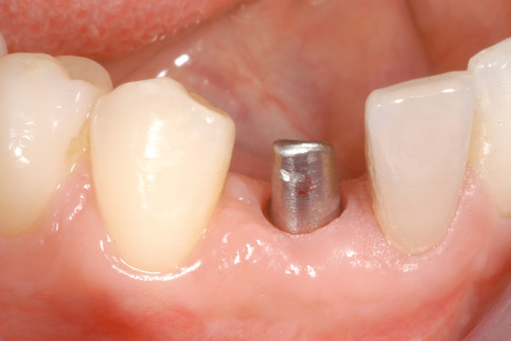 6. Al termine del trattamento ortodontico e dopo 4 mesi dall’inserimento dell’impianto, viene avvitata la mesiostruttura a livello di 43.