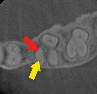 5. Il piano assiale della CBCT rivela  la presenza  del canale  mesio-buccale  (freccia gialla)  e del secondo canale mesio-buccale (freccia rossa)  in un primo molare mascellare.