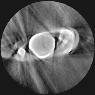 8. La distorsione dell’immagine della CBCT dovuta alla presenza di materiali da restauro coronale metallici che hanno causato dispersione e indurimento del fascio nei molari mascellari.