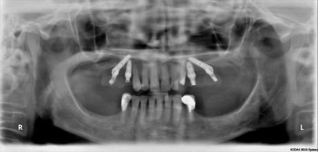 4. Ortopantomografia post-operatoria con i ponti provvisori applicati. Notare gli impianti anteriori mascellari inseriti in posizione assiale  e quelli posteriori inclinati distalmente. 
