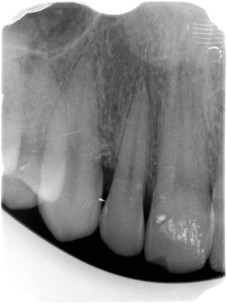 Fig. 10 - Radiografia a 2 mesi dall’intervento che mostra il riempimento del difetto angolare.