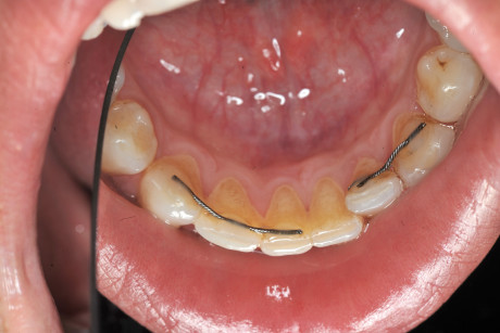 16. Caso di recidiva ortodontica nell’arcata inferiore, con disallineamento degli incisivi inferiori e rottura del filo metallico di splintaggio. 