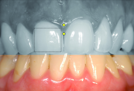 Fig 11a - Biotipo spesso-forma quadrata del dente. 