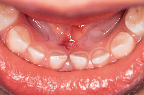 8. Particolare della disinserzione sulla parete linguale mandibolare.
