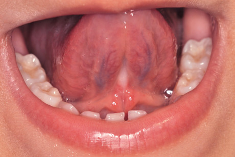 9. Sollevamento della punta della lingua sul palato a un mese dall’intervento.