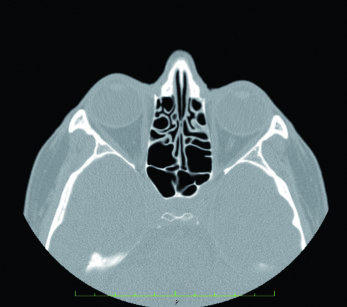 12-13. La tomografia di controllo conferma la normalizzazione del complesso naso-sinusale con pervietà dell’ostio sinusale (ovviamente allargato) e normale radio-trasparenza del seno mascellare e delle cellule etmoidali.