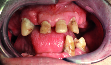 3. Presentazione clinica iniziale della situazione dento-gengivale.