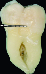 2. Lunghezza mesio-distale della cavità misurata con sonda parodontale.