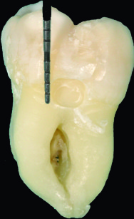 3. Lunghezza apico-coronale della cavità misurata con sonda parodontale.