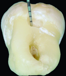 4. Profondità della cavità di 2 mm misurata con sonda parodontale.