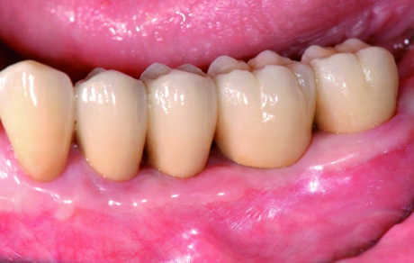7. La sovrastruttura protesica con le corone in perfetta armonia con i denti naturali permette il raggiungimento del successo estetico e delle condizioni ideali per il mantenimento dell’igiene.