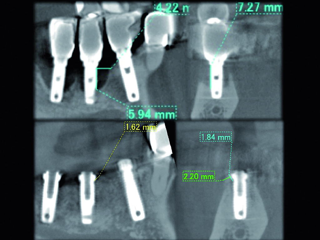 3. La figura superiore mostra la misurazione del riassorbimento osseo effettuata intorno all’impianto attraverso un esame radiografico di tomografia computerizzata cone beam. Si può osservare un grave riassorbimento osseo. La figura in basso mostra il guadagno di tessuto, sovrapponibile radiograficamente a osso, intorno all’impianto 10 mesi dopo. Il tessuto rigenerato si può notare chiaramente. È stato misurato sulla CT cone beam un aumento verticale di tessuto di 7,21 mm e orizzontale di 4,22 mm. 