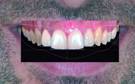 17. Inserimento dei denti dal database. In questo caso la riabilitazione estetica coinvolge 2.1,1.1 e 1.2.